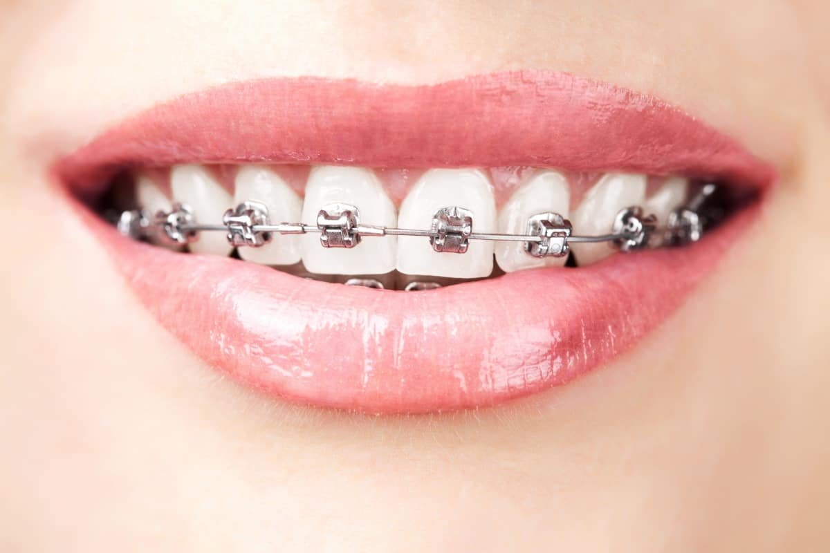 Braces & Aligners